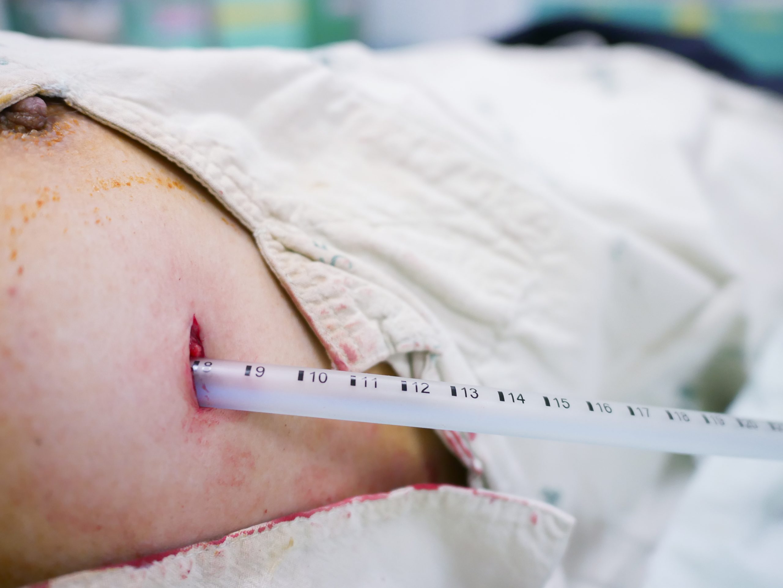 SGEM#300: The Lung is Up Where it Belongs - With or Without a Chest Tube | The Skeptics Guide to ...